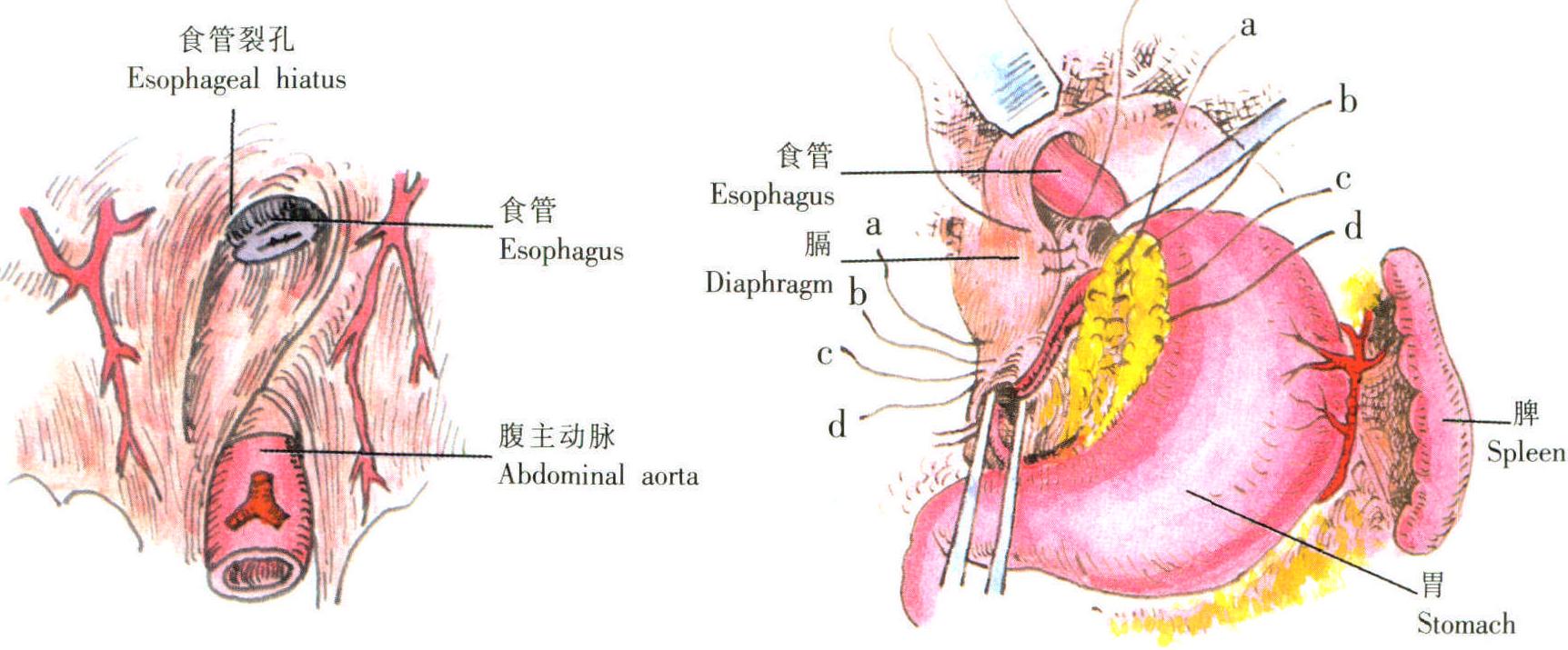 食管抗反流術(shù)